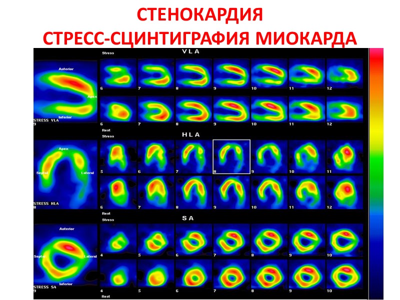 СТЕНОКАРДИЯ  СТРЕСС-СЦИНТИГРАФИЯ МИОКАРДА